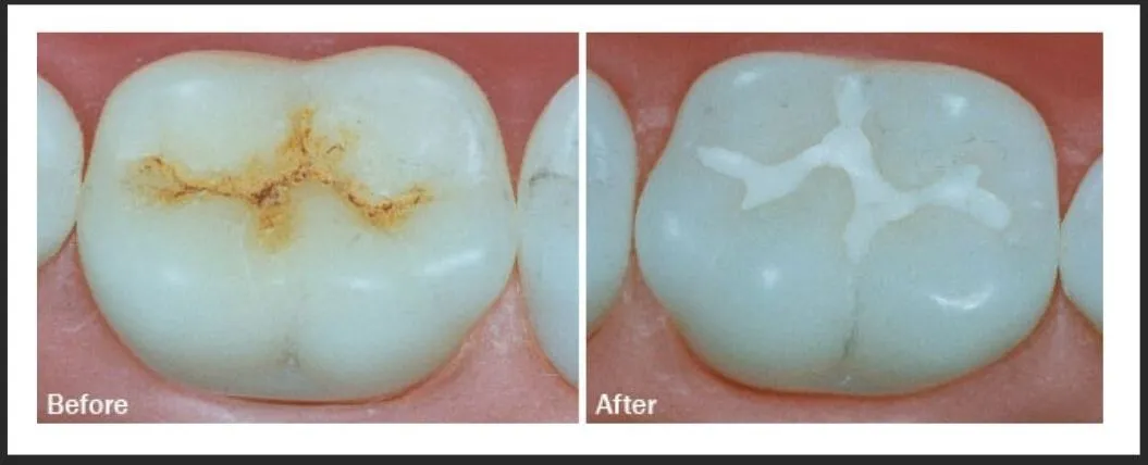 Early Teeth Care